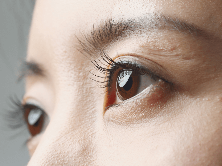 その他のクマ取り施術のご紹介